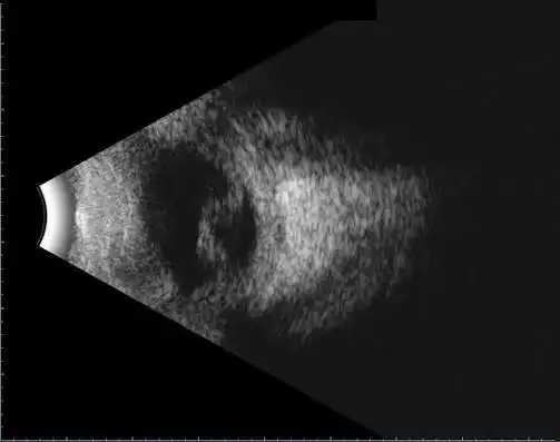 Ultrassonografia ocular
